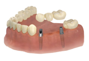 implantaat-tand-brug